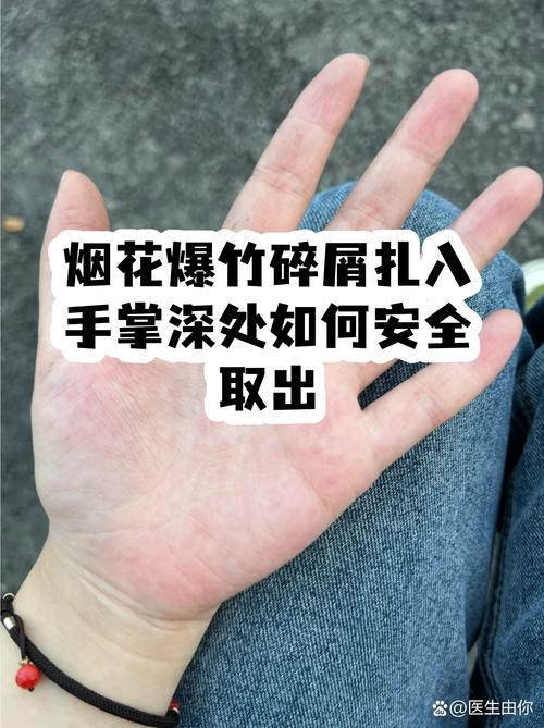 烟花爆竹碎屑扎入手掌深处如何安全取出